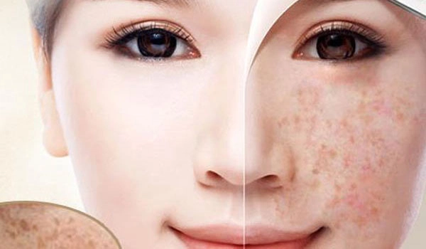 (Ảnh: Điều trị nám - tàn nhang bằng tia laser hiệu quả, nhanh chóng)