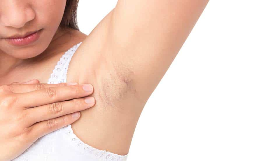 Cạo, nhổ lông không đúng cách rất dễ khiến da bị tổn thương và nhiễm khuẩn.